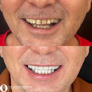 Antes e depois tratamento dentário