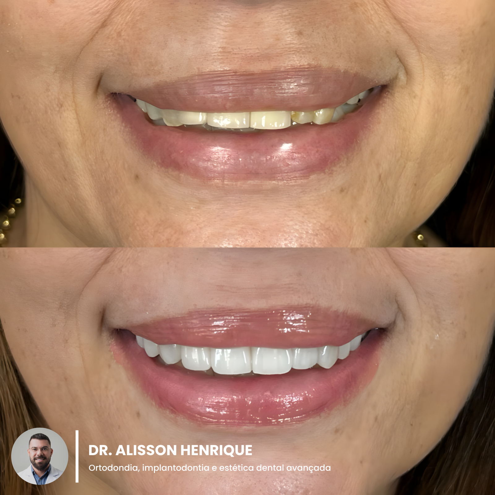 Antes e depois Dr. Alisson (1)